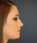 Feel Beautiful - Rhinoplasty 220 - Before Photo